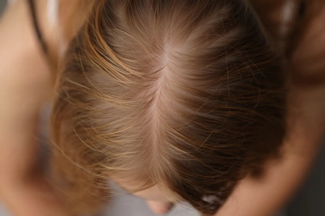 Chute de cheveux et perte de densité capillaire : que faire ?